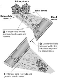 Stages in the process of metastasis