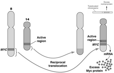 Chromosome translocation in Burkitt's lymphoma