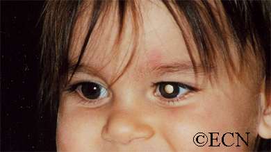 Hereditary vs. non-hereditary retinoblastoma