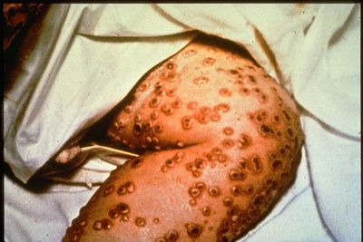 Image showing smallpox lesions on a patient's leg