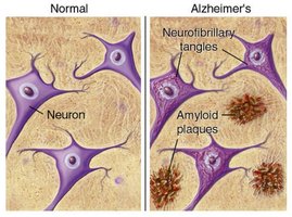 Comparison of normal neurons and Alzheimer's neurons with plaques and tangles