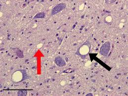 Brain tissue with vacuoles indicating cell death