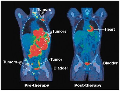 PET scan of cancer cells