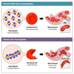 Normal vs. sickle cell hemoglobin and red blood cells