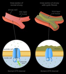 Normal vs. mutant CFTR channel in airway epithelium