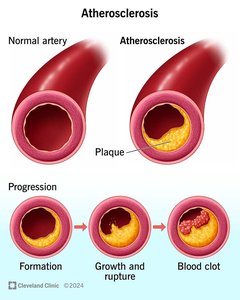 Atherosclerosis progression in arteries