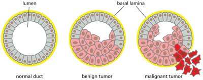 Diagram comparing normal duct, benign tumor, and malignant tumor
