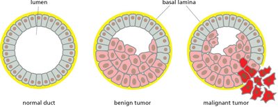 Benign vs malignant tumor diagram