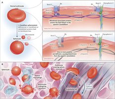 Hereditary spherocytosis: normal vs. spherocyte RBCs and clinical features