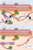 Deficiency of spectrin in hereditary spherocytosis