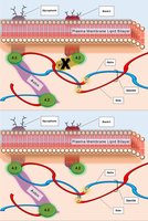 Deficiency of ankyrin in hereditary spherocytosis