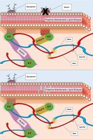 Deficiency of band 3 protein in hereditary spherocytosis