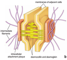 Epithelial to mesenchymal transition and intermediate filament changes