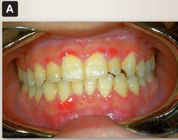 Clinical image of scurvy with bleeding gums