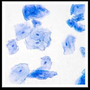Cluster of squamous epithelial cells stained blue