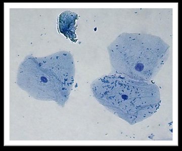 Close-up of three squamous epithelial cells showing nuclei and cytoplasm
