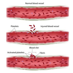 Diagram of blood vessel and clot formation