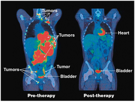 PET scan showing glucose uptake in tumors before and after therapy