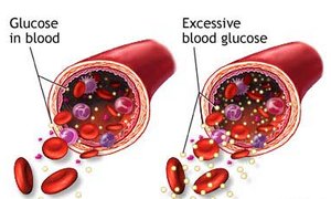 Diagram showing glucose and excessive blood glucose in blood vessels