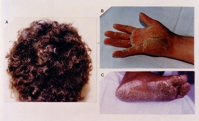 Naxos disease: woolly hair, hand, and foot phenotype