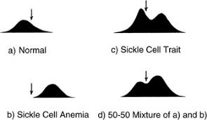 Sickle cell hemoglobin electrophoresis