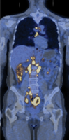 Medical scan showing cancerous regions in the human body