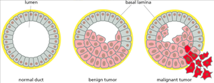 Diagram comparing normal duct, benign tumor, and malignant tumor