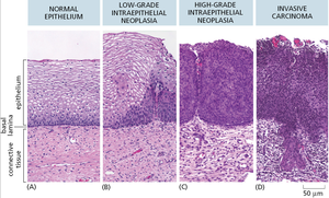 Histological images showing progression from normal epithelium to invasive carcinoma
