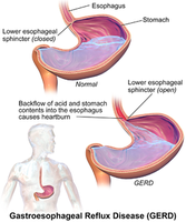 Diagram of GERD and acid reflux in the stomach and esophagus