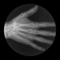X-ray image of a hand