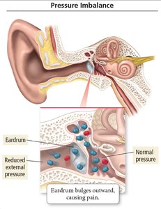 Diagram of ear showing pressure imbalance across the eardrum