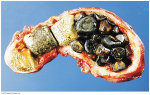 Gallstones formed from cholesterol