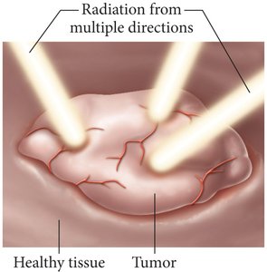 Radiation therapy targeting a tumor
