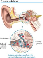 Pressure imbalance in the ear