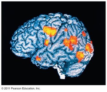PET scan of the brain