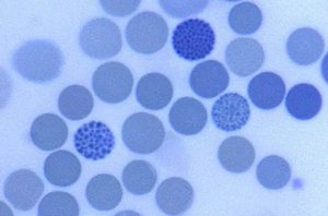Heinz-like bodies in hemoglobin H disease