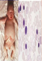Bart's hydrops fetalis syndrome