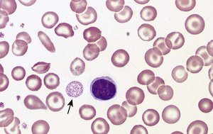 Basophilic stippling in RBCs