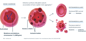 Bone marrow expansion in thalassemia major