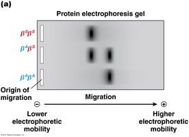 Protein electrophoresis gel for sickle cell hemoglobin