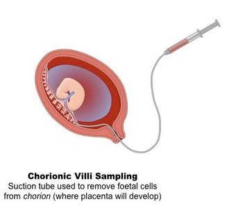 Chorionic villi sampling diagram