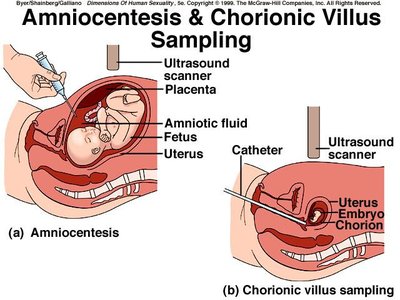 Amniocentesis and chorionic villus sampling comparison