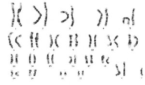 Karyotype of Jacob syndrome (XYY)