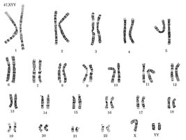 FISH image showing X and Y chromosomes in XYY syndrome