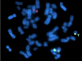 Karyotype of Triple X syndrome (XXX)
