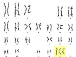 Karyotype of Turner syndrome (X0)