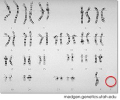 Diagram showing SHOX gene location on X and Y chromosomes