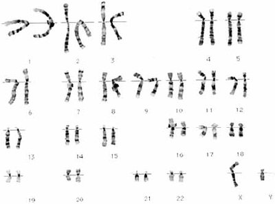 Human karyotype showing sex chromosomes