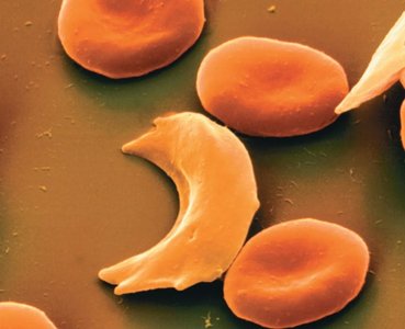 Sickled and normal red blood cells