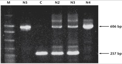 Gel electrophoresis image showing PCR results for albinism alleles in Navajo individuals